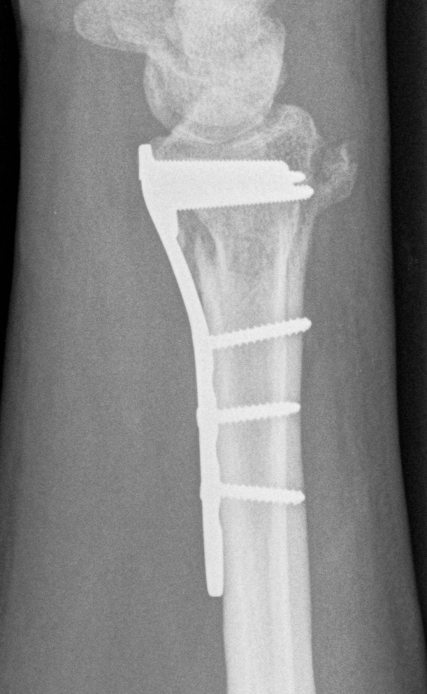 Distal Radius Plate Lateral